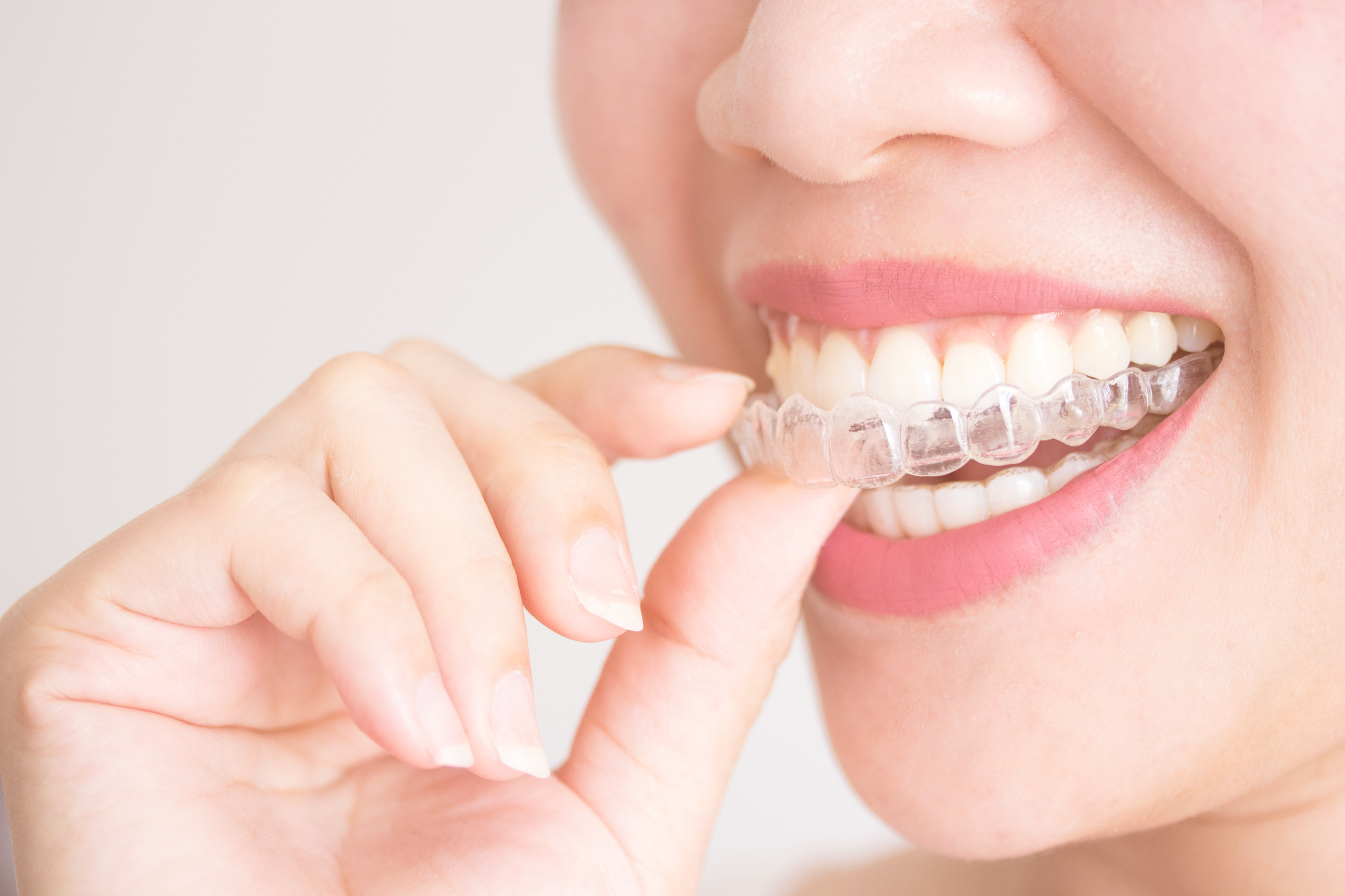 Basic aspects about the teeth clear aligners